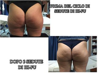 HI-FU prima e dopo