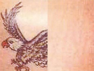 Rimozione tatuaggio prima dopo