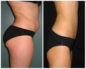 liposuzione addome prima e dopo