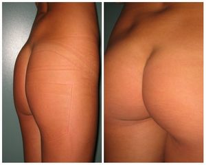 Gluteoplastica prima e dopo