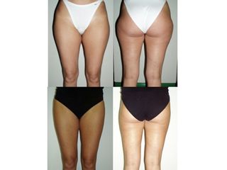 Liposuzione prima e dopo