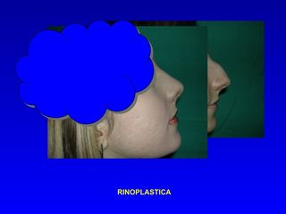 Rinoplastica prima e dopo