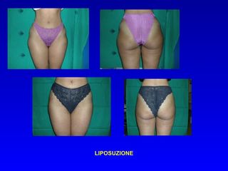 Liposuzione prima e dopo
