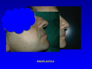 Rinoplastica prima e dopo