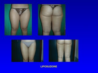 Liposuzione prima e dopo