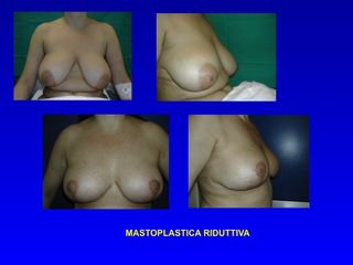 Mastoplastica riduttiva prima e dopo