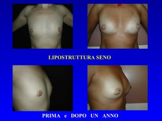 Lipostruttura seno prima dopo