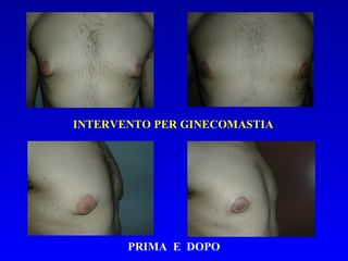 Ginecomastia prima e dopo