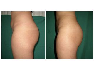 Liposuzione addome prima dopo