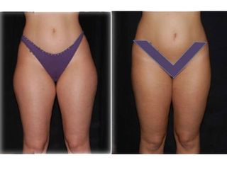 Liposuzione cosce prima dopo