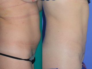 Lipoaddominoplastica prima e dopo