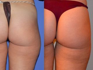 Liposuzione prima e dopo