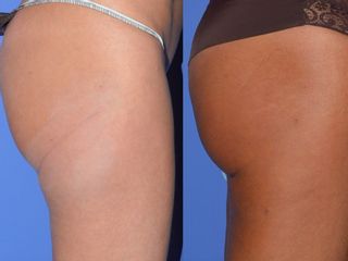 Glutei prima e dopo