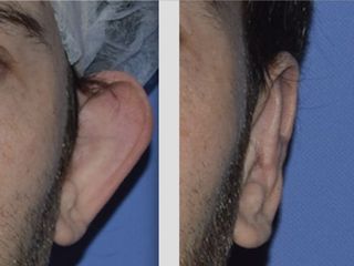 Otoplastica prima e dopo