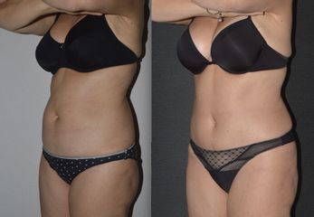 Lipoaddominoplastica prima e dopo