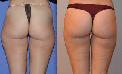 Liposuzione prima e dopo