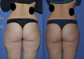 Liposuzione prima e dopo