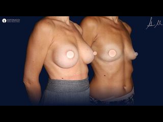 Mastoplastica additiva - Dott. Michele Antonacci