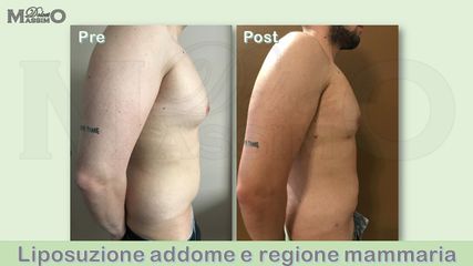 Liposuzione prima e dopo