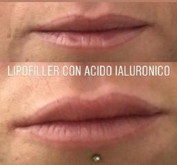 lipofiller prima e dopo