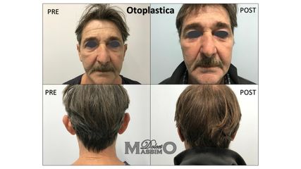 Otoplastica prima e dopo