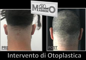 Otoplastica prima e dopo