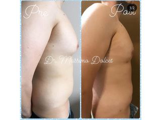 Liposuzione prima e dopo