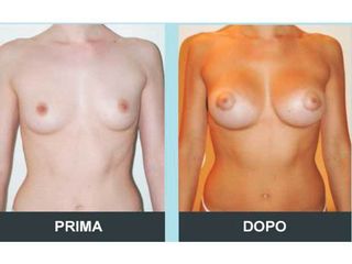 Mastoplastica additiva prima e dopo