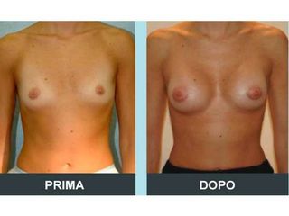 Mastoplastica additiva prima e dopo