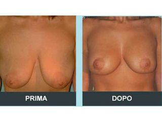 Mastopessi prima e dopo