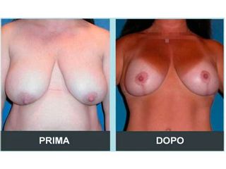 Mastoplastica additiva prima e dopo
