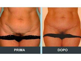 Addominoplastica prima e dopo