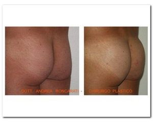 Gluteoplastica iniettiva