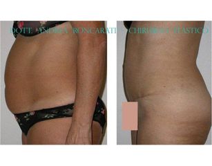 Addominoplastica e liposuzione