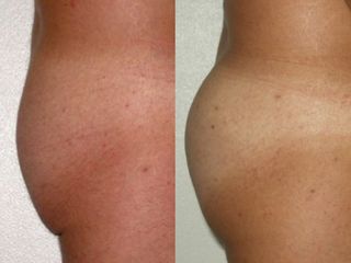 Gluteoplastica prima e dopo