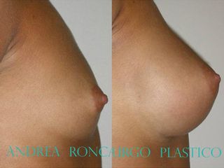 Mastoplastica additiva prima e dopo