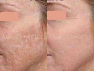 Peeling chimico prima e dopo - 871276