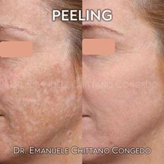 Peeling - Dott. Emanuele Chittano Congedo