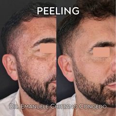 Peeling - Dott. Emanuele Chittano Congedo