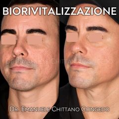 Biorivitalizzazione - Dott. Emanuele Chittano Congedo