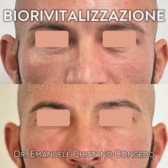 Biorivitalizzazione perioculare - Dott. Emanuele Chittano Congedo