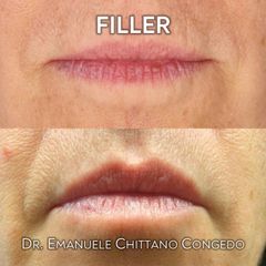 Filler labbra - Dott. Emanuele Chittano Congedo