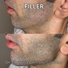 Filler mandibola - Dott. Emanuele Chittano Congedo