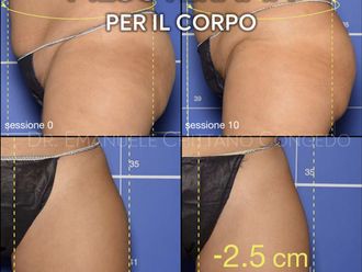 Mesoterapia prima e dopo - 871285