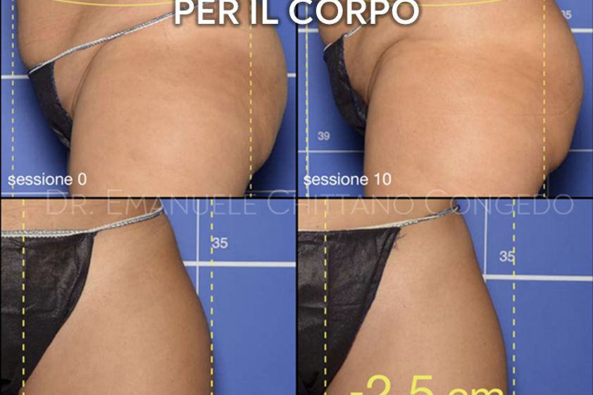 Mesoterapia prima e dopo - 871285