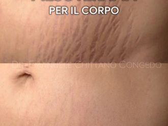 Mesoterapia prima e dopo - 871286