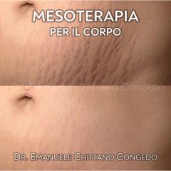 Mesoterapia - Smagliature - Dott. Emanuele Chittano Congedo