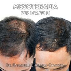 Mesoterapia per i capelli - Dott. Emanuele Chittano Congedo