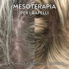 Mesoterapia per i capelli - Dott. Emanuele Chittano Congedo