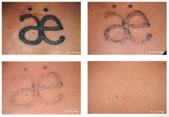 Asportazione tatuaggio prima e dopo